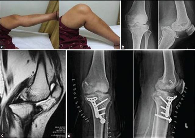 Внутрішньосуглобової перелом колінного, ліктьового суглоба, великогомілкової, променевої кістки