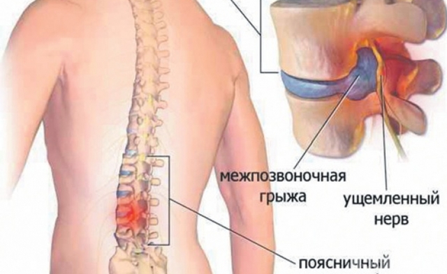 Комп'ютерна томографія хребта при міжхребцевої грижі: необхідність і шкода процедури 