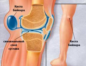 Болять коліна: що робити, причини болю в коліні при згинанні, при ходьбі