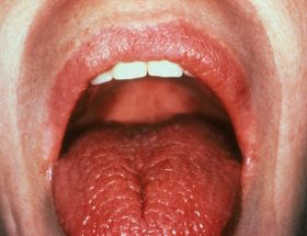 Причини сухості в роті: причина появи симптому, діагностика порушень і їх лікування