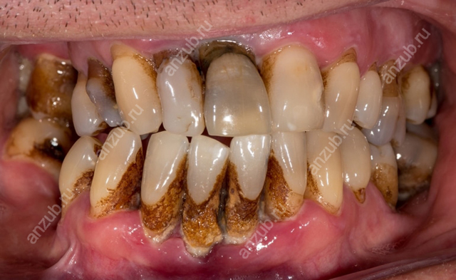 Металевий присмак при кашлі в роті: причини, діагностика та способи лікування