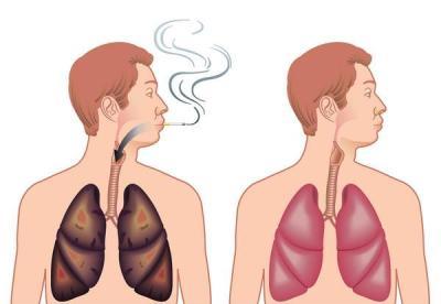 Емфізема легенів: симптоми, лікування, причини та діагностика емфіземи легенів.