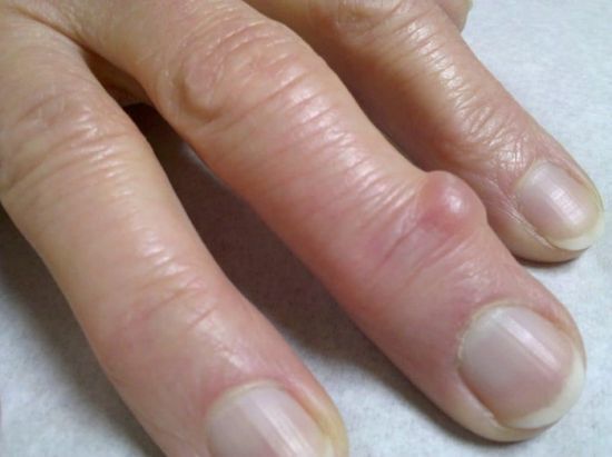 Нарости на суглобах пальців рук (шишки): види, причини, симптоми і лікування