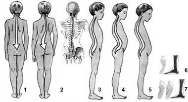 Кіфоз у дітей: симптоми, лікування, діагностика, причини і профілактика