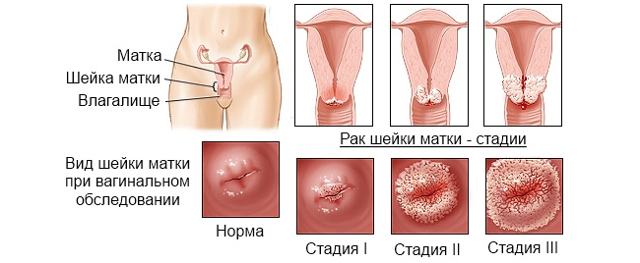 Перші ознаки раку шийки матки: симптоми і стадії
