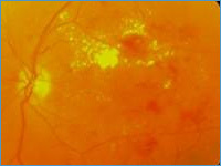 Діабетична ретинопатія - лікування, операція на очах при цукровому діабеті