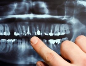 Периостит: причини запалення окістя, клінічні прояви, особливості лікування