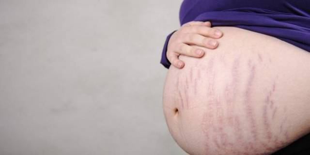 Чому з'являються розтяжки на шкірі: лікування розтяжок при вагітності, способи видалення стрий