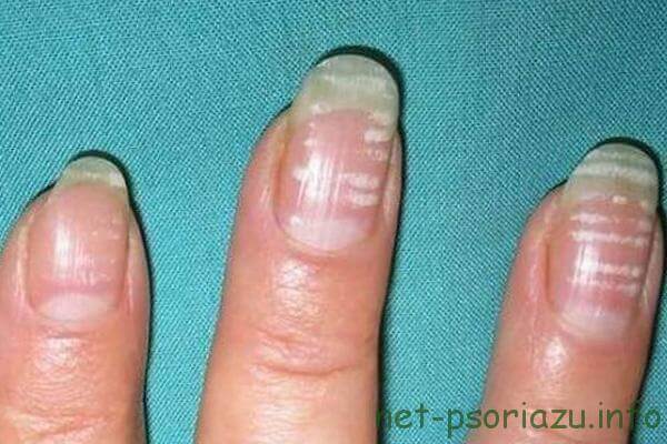 Псоріаз нігтів на руках і ногах: лікування, засоби при псоріазі нігтів