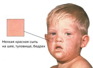 Ускладнення після щеплення від дифтерії, кору і краснухи, поліомієліту, гепатиту: симптоми, профілактика