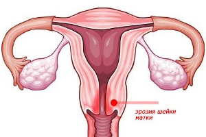 Що таке ерозія шийки матки і чим вона небезпечна