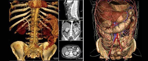 Комп'ютерна томографія органів черевної порожнини: показання, протипоказання, підготовка до процедури