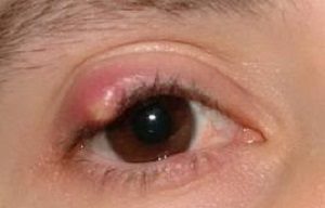Болить очей під верхньою повікою і боляче натискати, причини болю при моргання