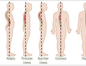 Сколіоз (трёхплоскостная деформація хребта): причини появи у дітей і степу ні хвороби