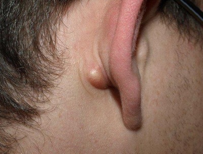 Ліпома вуха: що це таке, причини, симптоми, лікування жировика мочки вуха