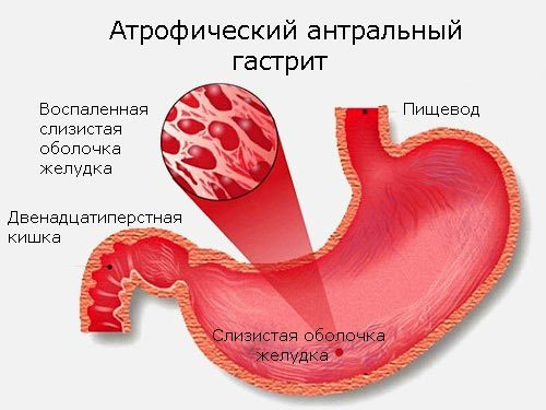 Антральний гастрит з атрофією слизової: причини, симптоми, лікування у дорослих