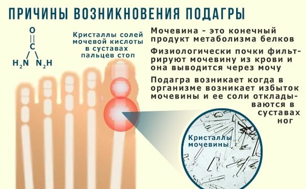 Подагра: ознаки і лікування в домашніх умовах, лікування подагри народними засобами