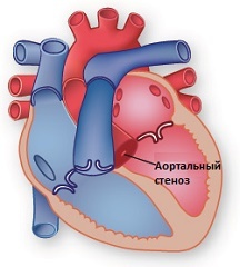 Аортальний стеноз: причини виникнення та симптоми, показання для операції і лікування медикаментами