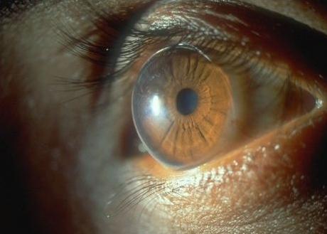Кератотопографія рогівки ока: показання та результати