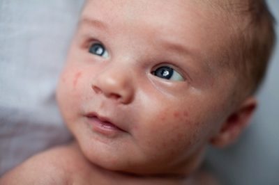 Цвітіння немовлят: причини акне у новонароджених, лікування гормональної висипу