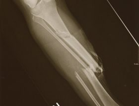 Коли видаляти металоконструкції після перелому гомілкової кістки?