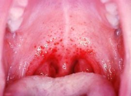 Висип при ангіні і біль в горлі: причини у дитини і дорослого, лікування