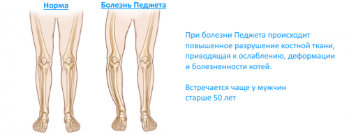 Що таке сцинтиграфія кісток і органів, що показує сцинтиграфія