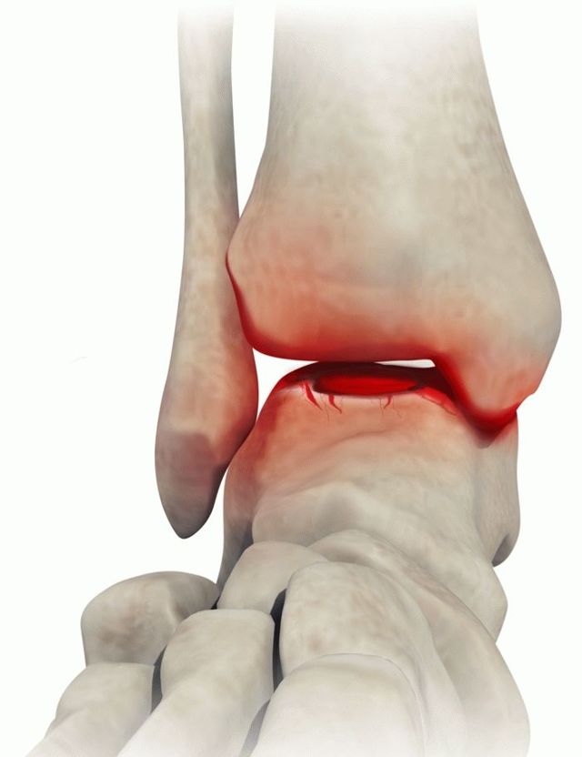 Гнійний артрит колінного, гомілковостопного, тазостегнового і плечового суглоба: лікування