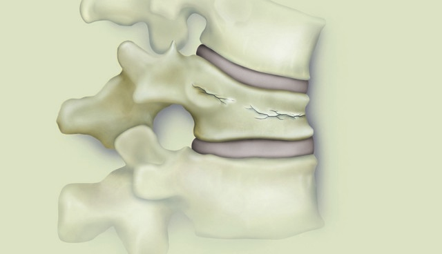 Компресійний перелом хребта грудного, поперекового відділу: що це, діагностика