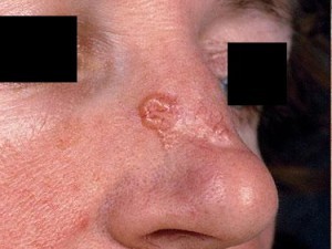 Освіти на шкірі носа: причини, види, лікування та профілактика