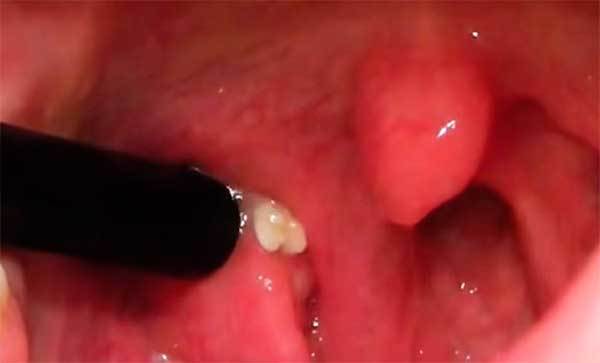 Від чого виникають білі смердючі кульки в горлі?
