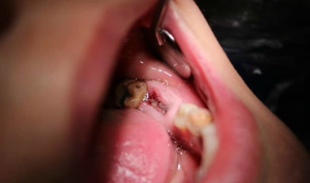 Ускладнення після видалення зуба: щось біло в лунці, суха лунка, біль, температура