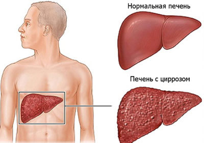 Інтоксикація печінки: симптоми і лікування, допомога при харчовому і алкогольне отруєння