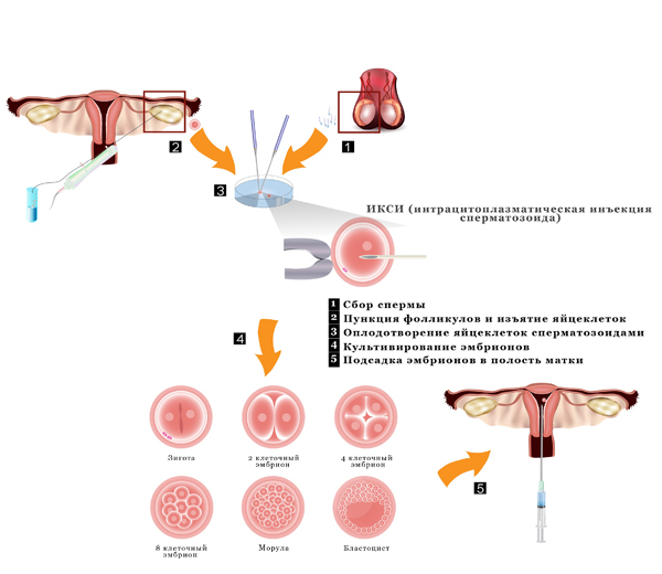 ІКСІ-запліднення: що це таке, відміну ЕКО і ІКСІ, вагітність при ІКСІ