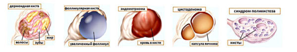 Ендометріоїдна кіста яєчника: способи лікування без операції