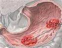 Доброякісні пухлини шлунка: симптоми, лікування, ускладнення, ризики раку
