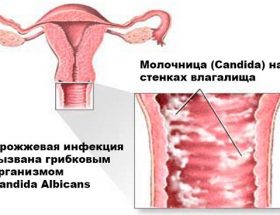 Молочниця при грудному вигодовуванні у матері-годувальниці: симптоми, безпечні препарати для лікування