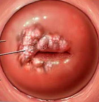 Що таке ерозія шийки матки і чим вона небезпечна