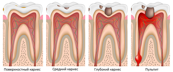 Дентамет Гель стоматологічний: інструкція із застосування, склад, аналоги