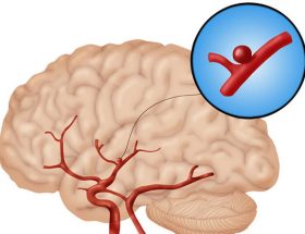 Розширення судин (вен) головного мозку