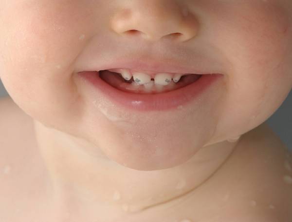 Плями на зубах - білі, жовті, коричневі, чорні: причини і лікування