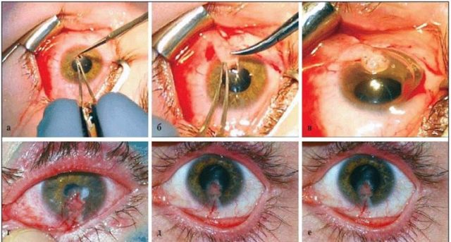 Захворювання рогівки ока: фото, опис хвороб