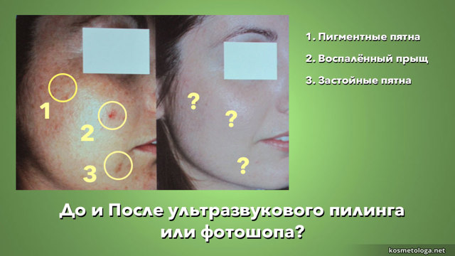 Ультразвукова чистка обличчя: що це таке, протипоказання до ультразвукового пілінгу