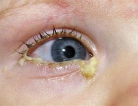 У дитини нежить і гниють очі: причини і лікування