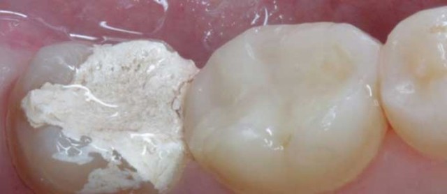 Може закладати миш'як дітям стоматолог при лікуванні зубів?