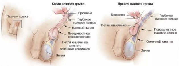 Біль в паху у чоловіка: причини болю справа і зліва в паху, до якого лікаря йти