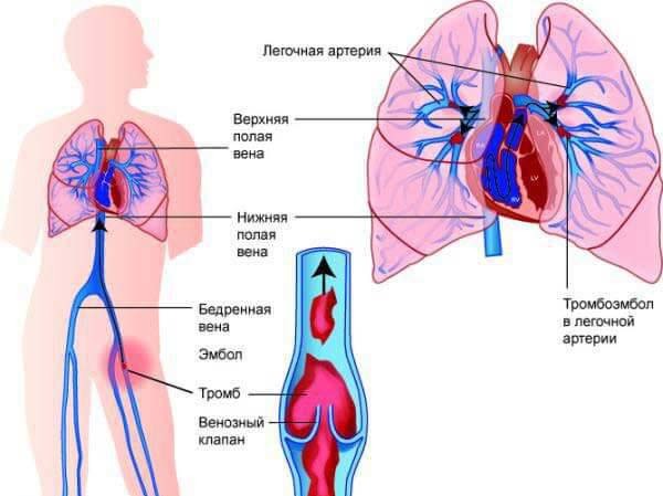 Тромбоемболія легеневої артерії: симптоми, лікування, діагностика ТЕЛА і ускладнення