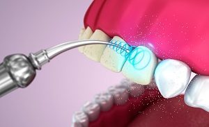 Професійне чищення зубів: види, показання, особливості проведення гігієнічної процедури в домашніх умовах