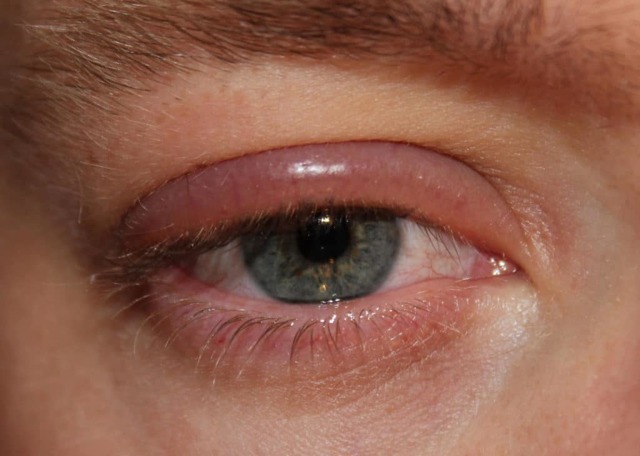 Грибок очей: симптом і лікування грибкового захворювання на століттях очей, фото