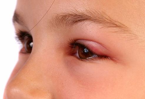 Алергічний набряк повік: лікування очей, причини, симптоми